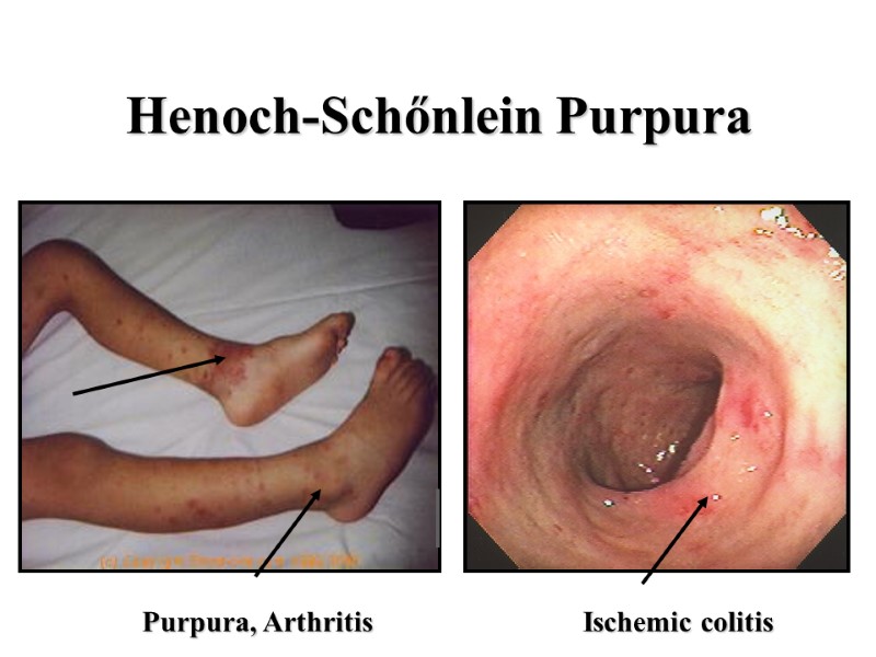 Henoch-Schőnlein Purpura Purpura, Arthritis      Ischemic colitis